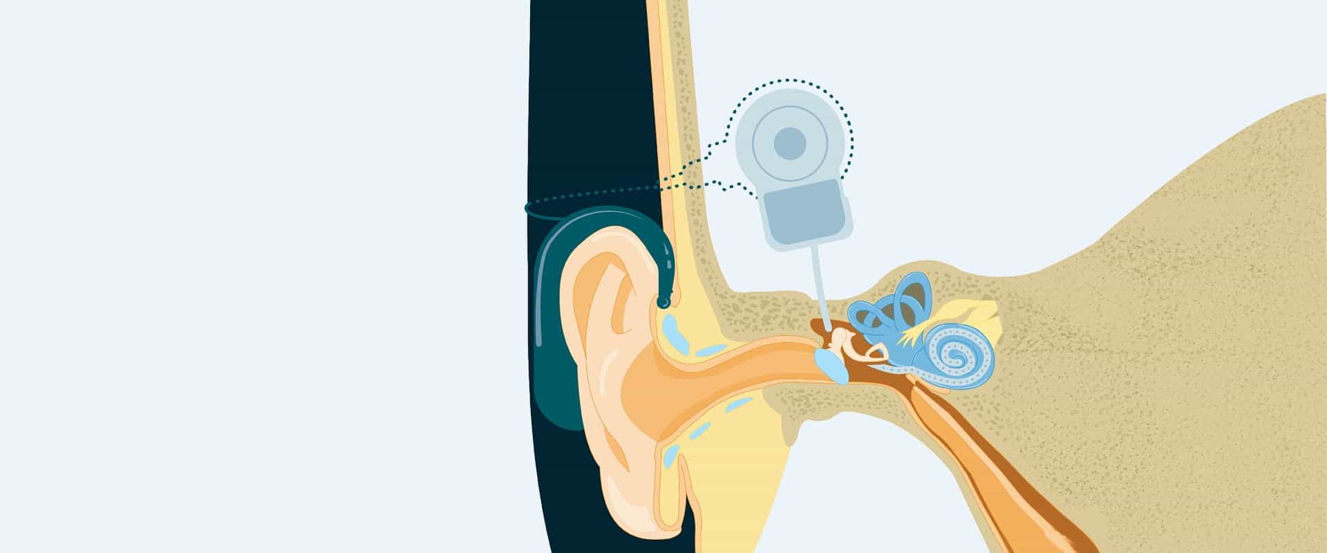 Cochlear Implantation: The Most Misunderstood and Under-Recommended Treatment Option in Audiology Header Image (mmutlu/Shutterstock.com and S. Chanesman)