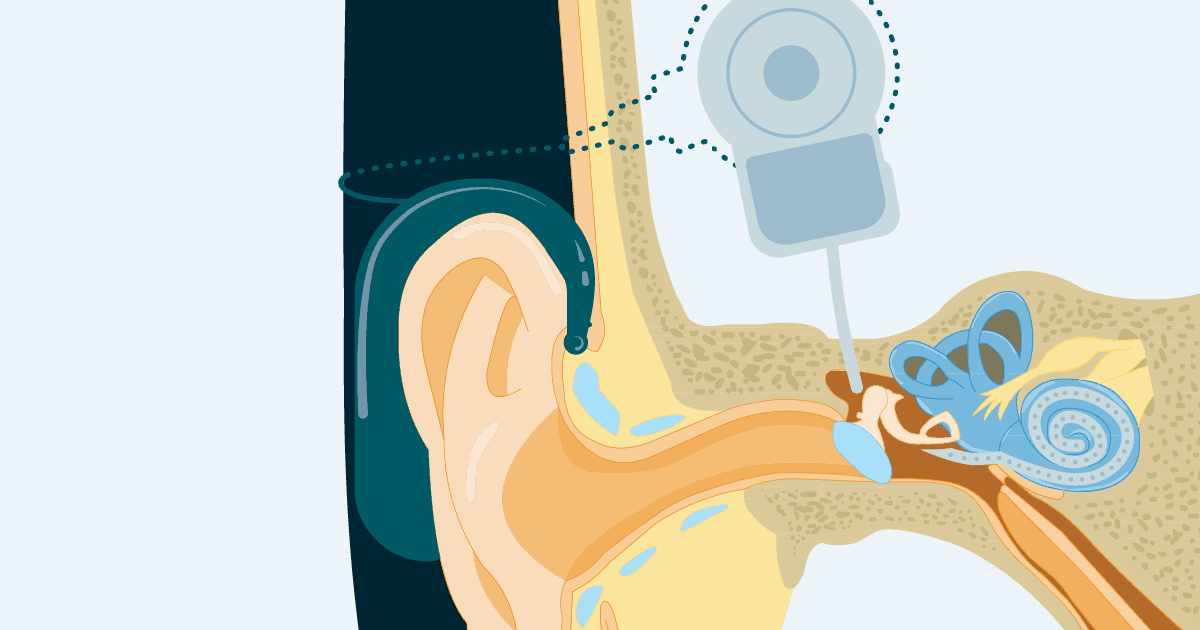 Cochlear Implantation The Most Misunderstood and