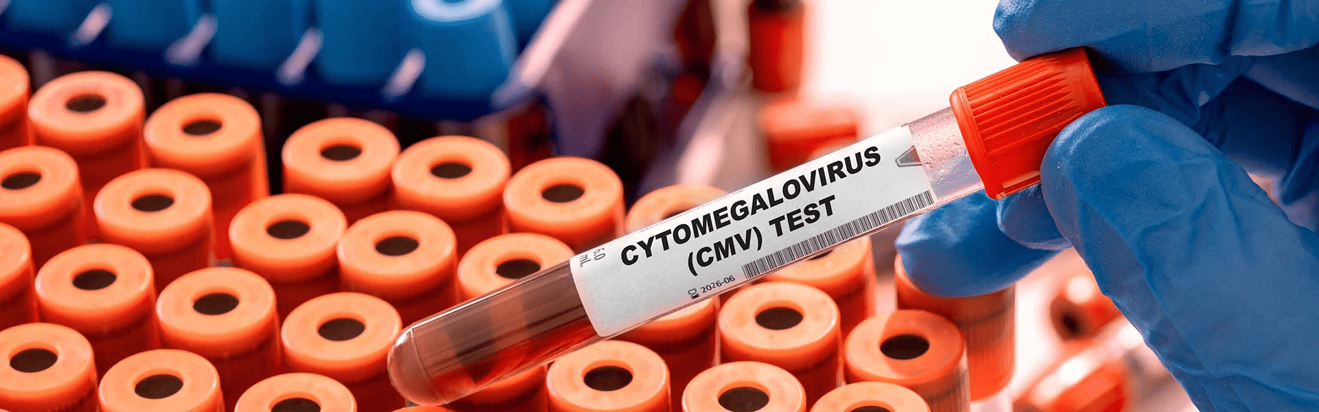 Cytomegalovirus (CMV) Test tube with blood sample in infection lab